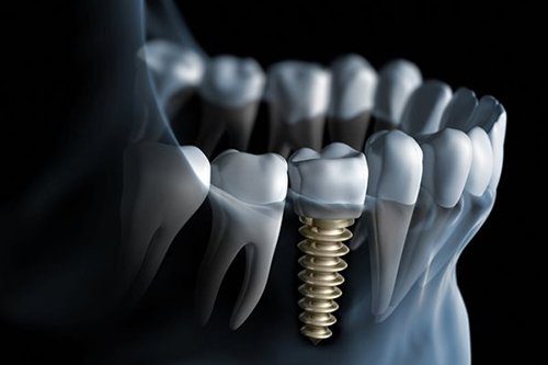 Implant ngăn ngừa tiêu xương hàm