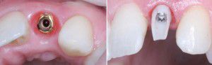 Implant sau nhổ răng