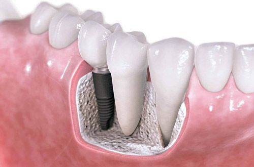 Implant được cấy vào xương hàm giúp răng ăn nhai tốt và thẩm mỹ cao như răng thật