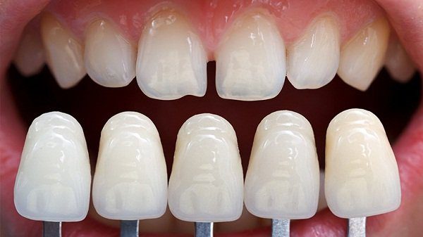 Bọc răng sứ  cho răng cửa như thế nào?  
