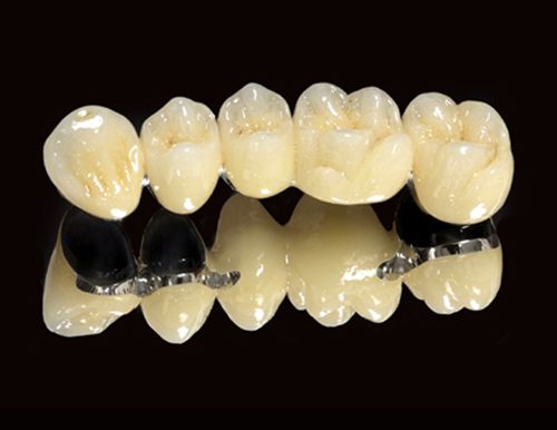 Bọc răng sứ titan có ưu và nhược điểm gì ?
