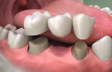 Cách chăm sóc răng giả