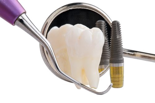 Cấy răng implant ngay sau khi nhổ răng được không ?