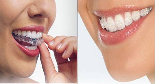 Chăm sóc răng sau khi tháo mắc cài