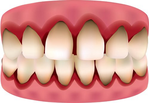 Chảy máu nướu răng nguyên nhân và cách phòng tránh