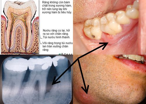 Triệu chứng và dấu hiệu viêm chân răng