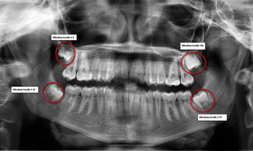 Làm gì khi răng khôn hàm dưới mọc lệch ?