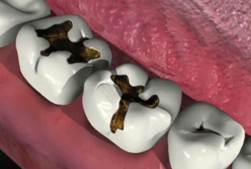Làm sao để sớm phát hiện răng sâu ?