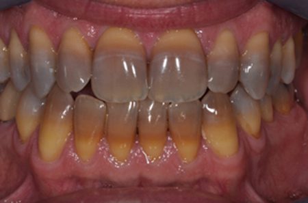 Làm trắng răng bị nhiễm tetracycline