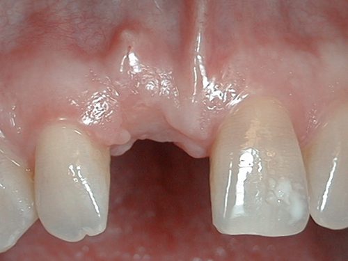 Mất một răng nên trồng răng sứ hay cấy implant