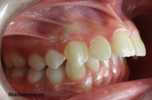 Niềng răng hô thời gian bao lâu ?