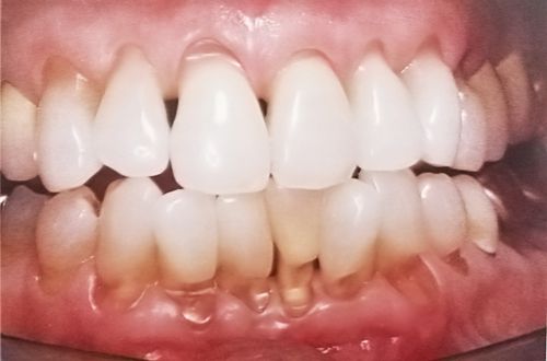 Răng bị mòn điều trị như thế nào