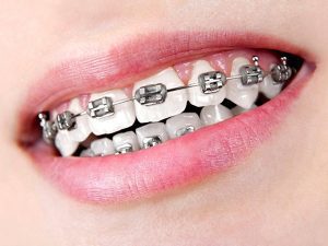 Khi răng hô nhẹ nên niềng răng hay bọc sứ?