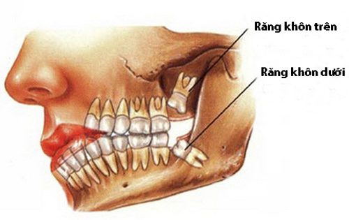 Răng khôn hàm trên mọc lệch phải làm sao ?