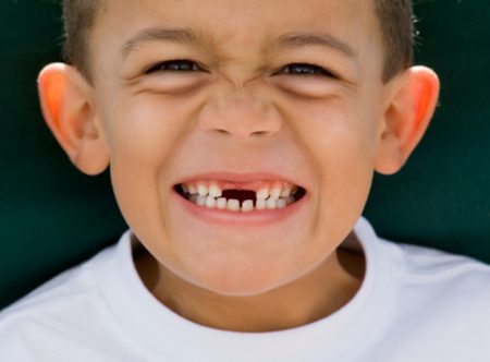 Trẻ thay răng sữa chậm