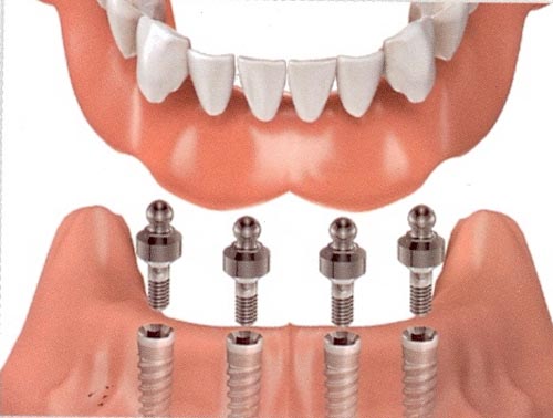 <br/<br /><br/ Trồng răng implant có đau không ?